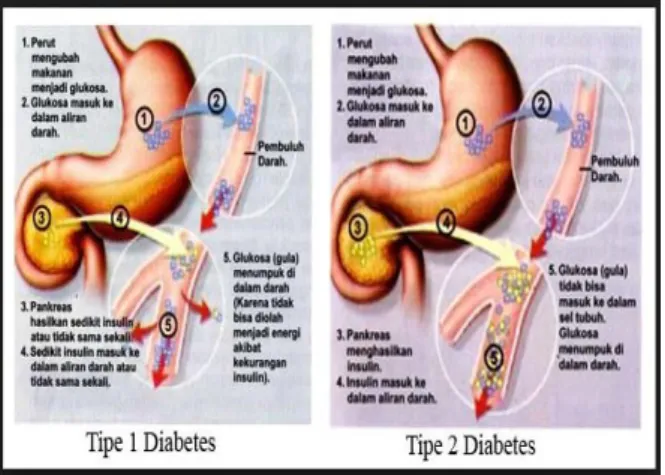 Gambar 2.2 DM tipe I DM tipe II 