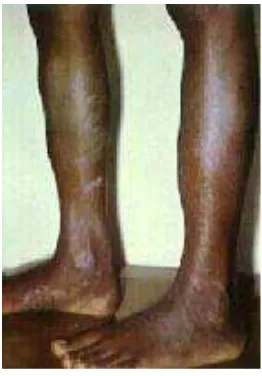 Gambar 4. Osteoperiostitis pada tibia dan fibula 