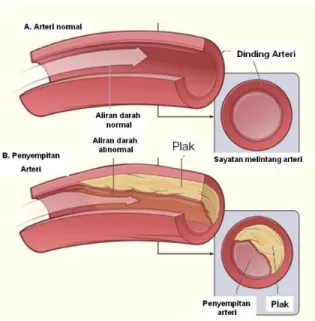 Gambar 5. Atherosklerosis (National Heart and Lung Institute, 2015)