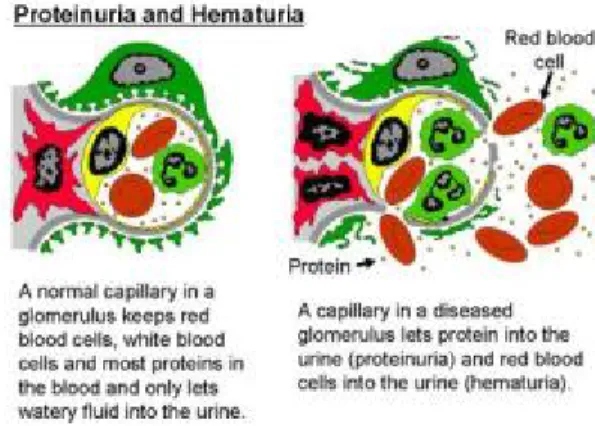 Gambar 7.proses terjadinya proteinuria dan hematuria