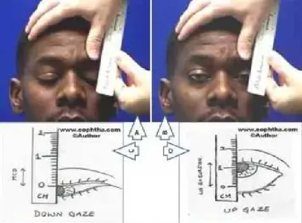 Gambar 3.8 Pemeriksaan Levator FunctionGambar 3.8 Pemeriksaan Levator Function 5.