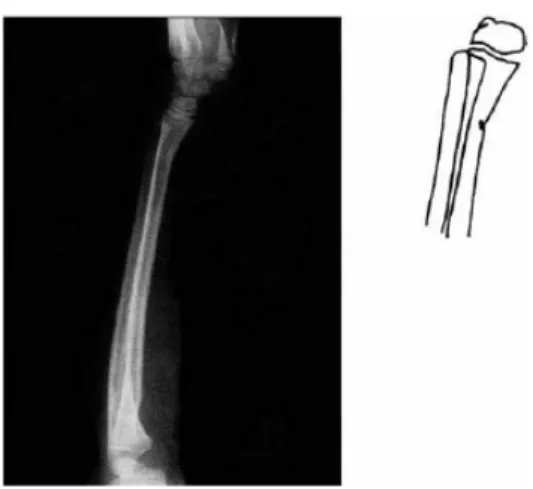 Gambar 5. Greenstick fracture pada radius distal seorang anak.