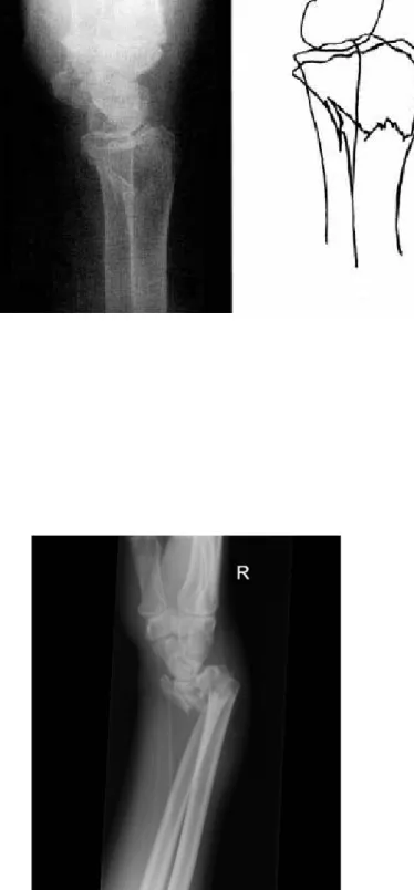 Gambar 8. Peradangan lateral pergelangan tangan memperlihatkan fraktur smith (kebalikan dari fraktur colles) (8, 13)