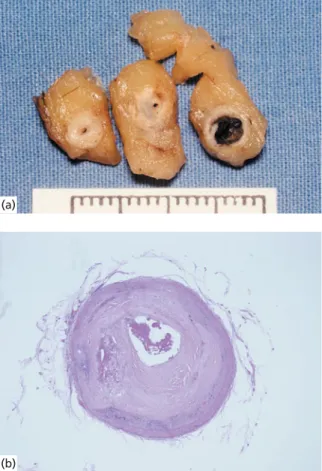 Figure 6.1 Signiﬁ cant coronary artery atherosclerosis  and acute thrombosis. Macroscopic (a) and microscopic  (b) appearance.