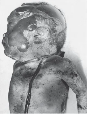 Figure 7.1 Maceration following intrauterine death. Note the  widespread skin slippage and the umbilical cord around the  neck.