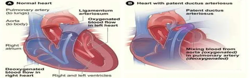 Gambar 1 Jantung dengan VSD