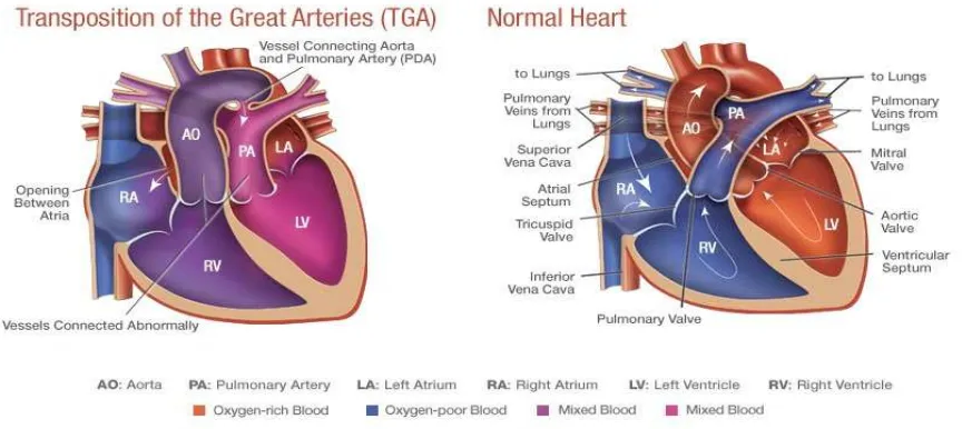 Gambar 3 TGA dan Normal Jantung