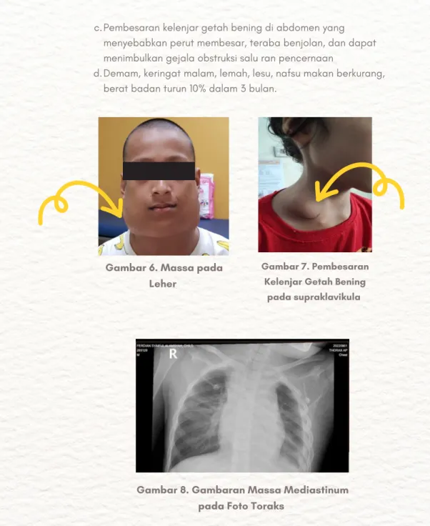 Gambar 6. Massa pada  Leher 