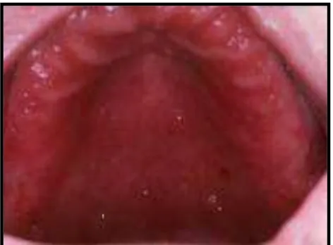 Gambar 3. Denture stomatitis