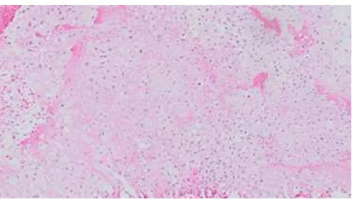 Figure 3 Microscopic Appearances of Anaplastic Chondrocytes within A Chondrosarcoma     (Objective 10x)