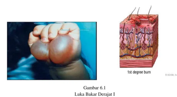 Gambar 6.1 Luka Bakar Derajat I