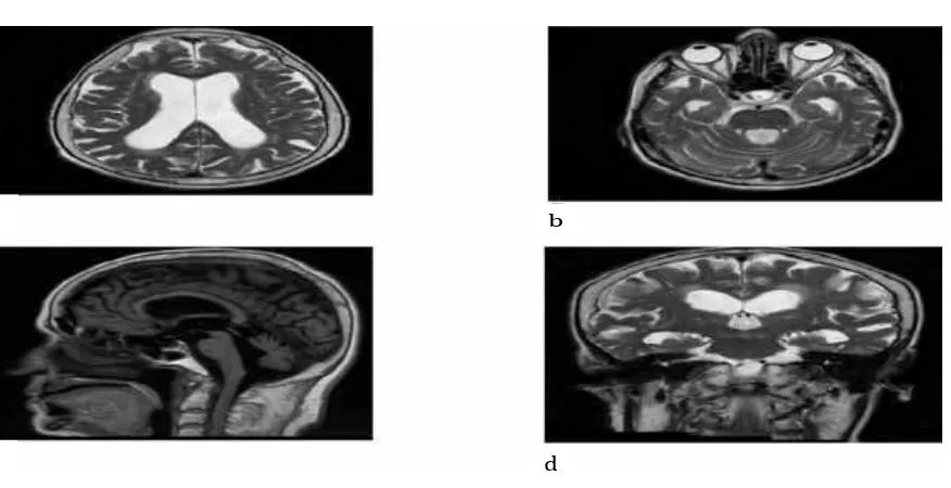 Fig. 1Fig. 1a, b, c, d: Enlarged Temporal Horns are Seen on the Axial T2-weighted Images Increased Curvature of Corpus Callosum and Normal Size 4th Ventricle are Seen on the Sagittal MRI Image Enlarged Lateral and 3rd Ventricle are Seen on the Coronal MRI Image