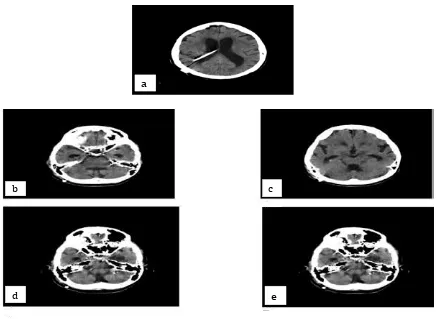 Fig. 2Shunt Catheter was Seen on the Postoperative CT Image. Fig. 2b, c, d, e: Multiple Millimeter-sized Hyperdense Myodil Remnants were Observed in the Posterior Cisterns, Prepontine Cistern, Lateral Ventricles and Sylvian Fissures.