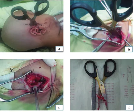 Fig. 4Intraoperative Findings. The Patient was Put in Supine Position with Her Head Slightly Turned to the Left (a)