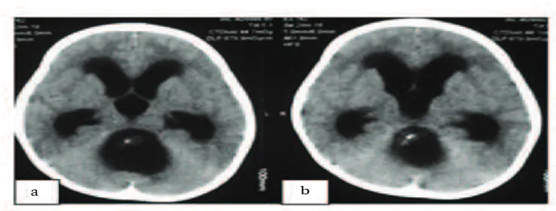 Fig. 2a, b Intraoperative Photographs. After Suboccipital Craniotomy and the Process of Debulking