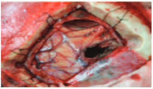 Fig. 3Mass Located in Interhemispheric Space