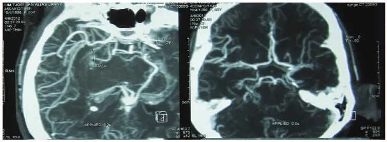 Fig. 1Both SidePreoperative-axial Head CT-scan Showing an Intraventricular Hemorrhage on 