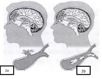 Gambar 2. Jenis Stroke 