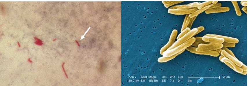 Gambar �. M. tuberculosis dalam pewarnaan tahan asam �kiri� dan melalui mikroskop elektron �kanan�. CDC 
