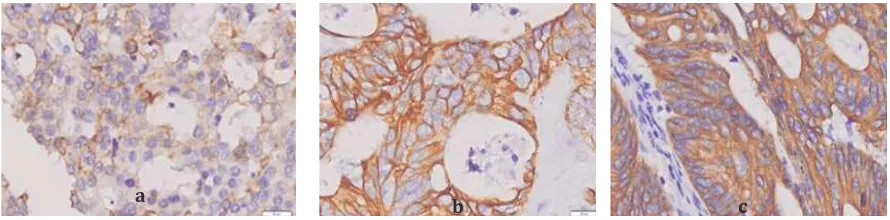 Gambar Pulasan Imunoekspresi VDR Intensitas Kuat. b. Intensitas Sedang. c. Intensitas Lemah   (Pembesaran 400x)