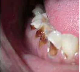 Gambar 2. Karies gigi  Ketika gigi menjadi berlubang, karies ataupun karang 