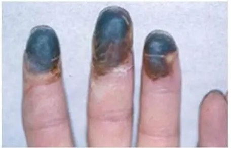Gambar 2.3 Ujung jari penderita penyakit Buerger