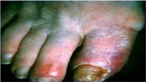 Gambar 2.5 Trombophlebitis superficial ibu jari kaki penderita penyakitBuerger