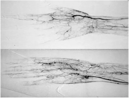 Gambar  2.6 Sebelah  kiri  merupakan  gambaran  angiografi  normal.Gambar sebelah kanan merupakan gambaran angiografi abnormal dariarteri  tangan  dengan  gambaran  khas  “corkscrew”  di  daerah  lengan.Perubahannya  terjadi  pada  bagian  kecil  pembuluh  dari  lengan  kananbawah pada daerah distribusi arteri ulnaris.