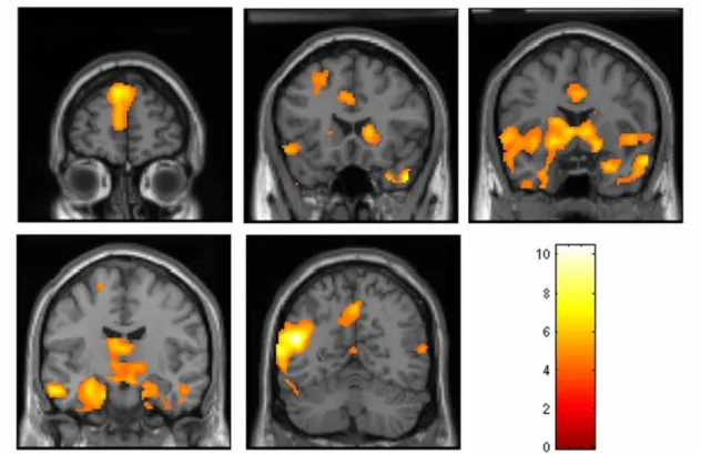 Figure 12  Coronal views of group contrast map for activity that correlates linearly with cartoon rating  (increased activity with higher rating of funniness)