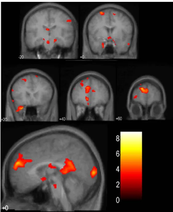 Figure 13  Statistical parametric analysis in which women had greater activity than men,  overlaid on the average of the female structural scans (p<0.005, uncorrected)