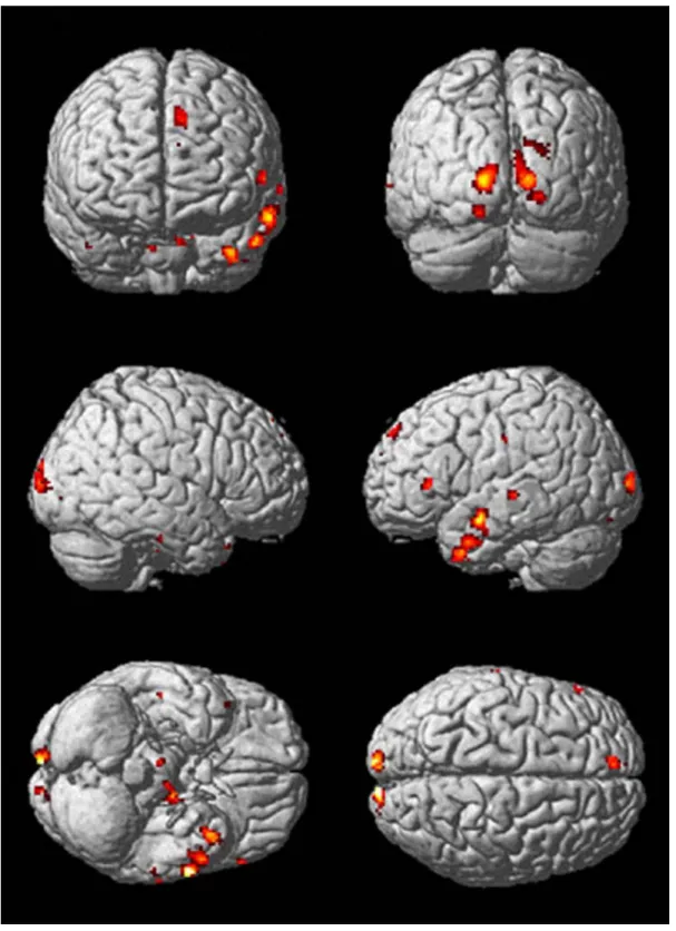 Figure 18  Surface rendering of brain regions for which language humor is greater than visual humor  (p<0.05, uncorrected).