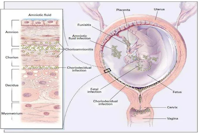 Gambar 1. tempat yang potensial untuk infeksi bakteri di dalam uterus1