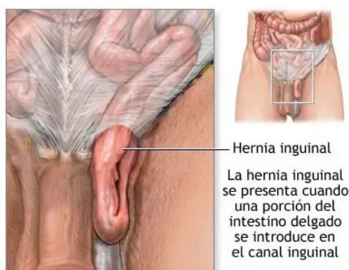Gambar 5. Hernia Inguinalis Direct