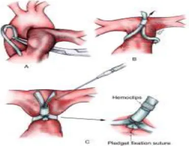 Gambar 8. Penjeratan (banding) arteri pulmonalis.
