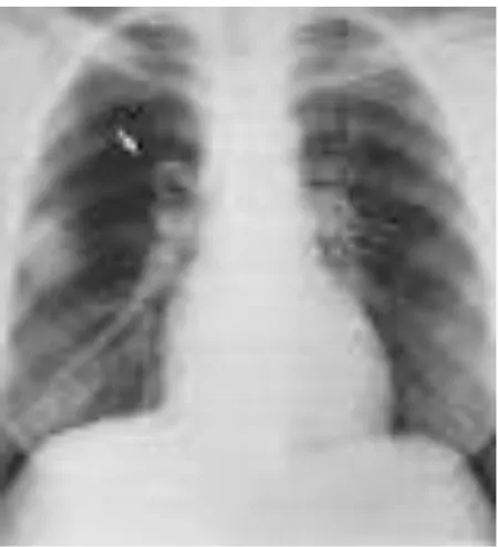 Gambar 2.2 Pulmonary Acute Emboli