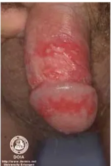 Gambar 6. Lesi herpes pada penis5
