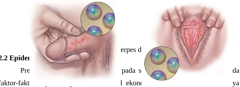 Gambar 1. Lesi Herpes di alat kelamin1