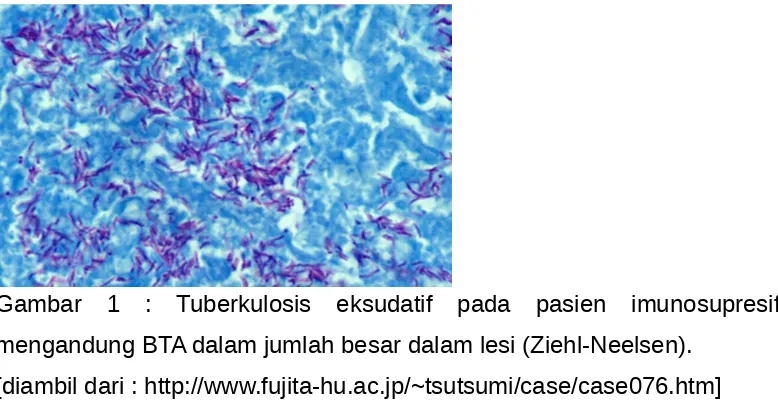 Gambar  1  :  Tuberkulosis  eksudatif  pada  pasien  imunosupresif,