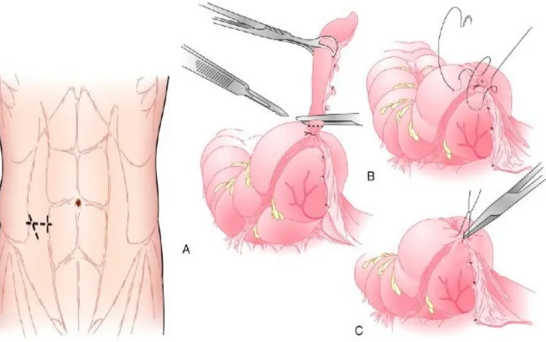 Gambar 7. Appendectomy secara Singkat