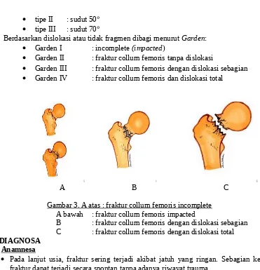Gambar 3. A atas : fraktur collum femoris incomplete