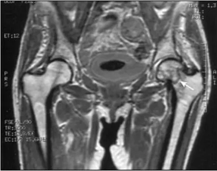 Gambar 7. MRI potongan coronal T1, tampak fraktur collum femoris sinistra tanpadislokasi.