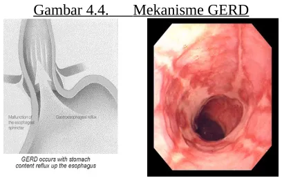 Gambar 4.4.         Mekanisme GERD