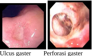 Gambar 4.8 Ulkus Gaster