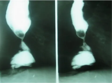 Gambar Pemeriksaan Radiologis dengan Bubur Barium (OMD)