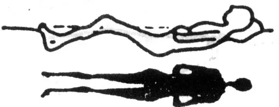 Gambar 4.Penderita berbaring di atas kasur air, dengan temperatur airdapat diatur sesuai yang diinginkan