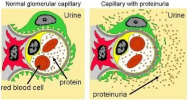 Gambar 2.8 Kapiler glomerulus normal dan dengan proteinuria
