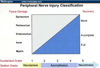 Gambar 1. Grafik yang menggambarkan tingkatan cedera saraf menurut Sunderland dan