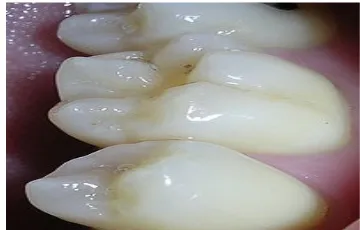 Gambar 1. Celah atau fisura gigi dapat menjadi lokasi karies