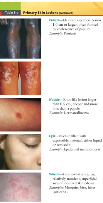 Table 6-2 Primary Skin Lesions  ( continued )