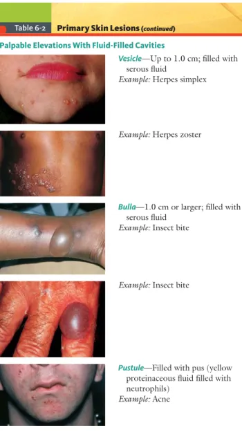 Table 6-2 Primary Skin Lesions  ( continued )